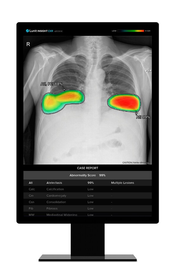 Lunit's chest X-ray AI analysis solution 'Lunit INSIGHT CXR'